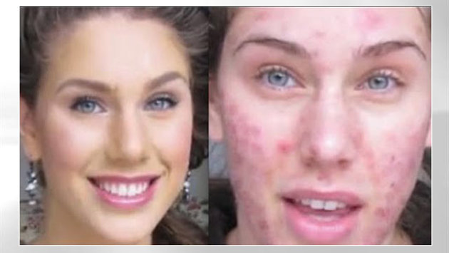 Bullies Turned an Acne-Plague Teenager into a Runway Model 